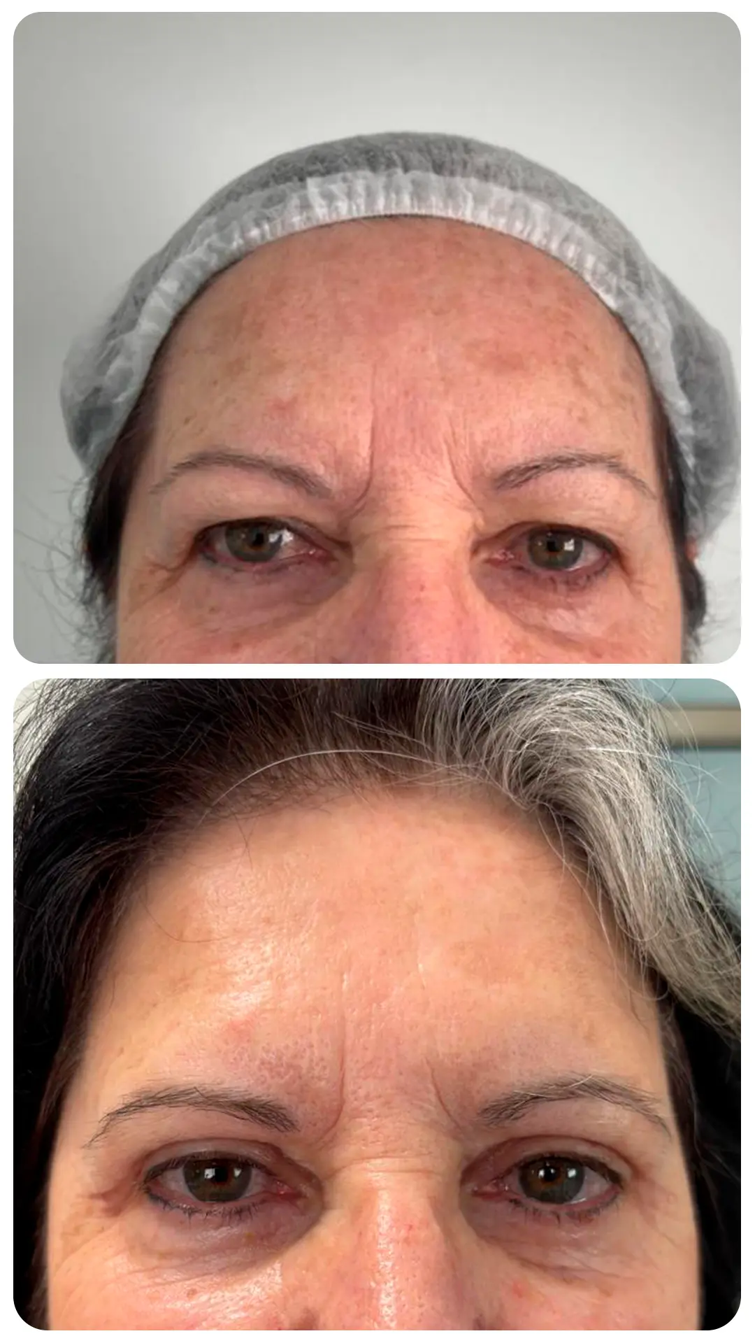 Blefaroplastia — antes e depois (caso 3)