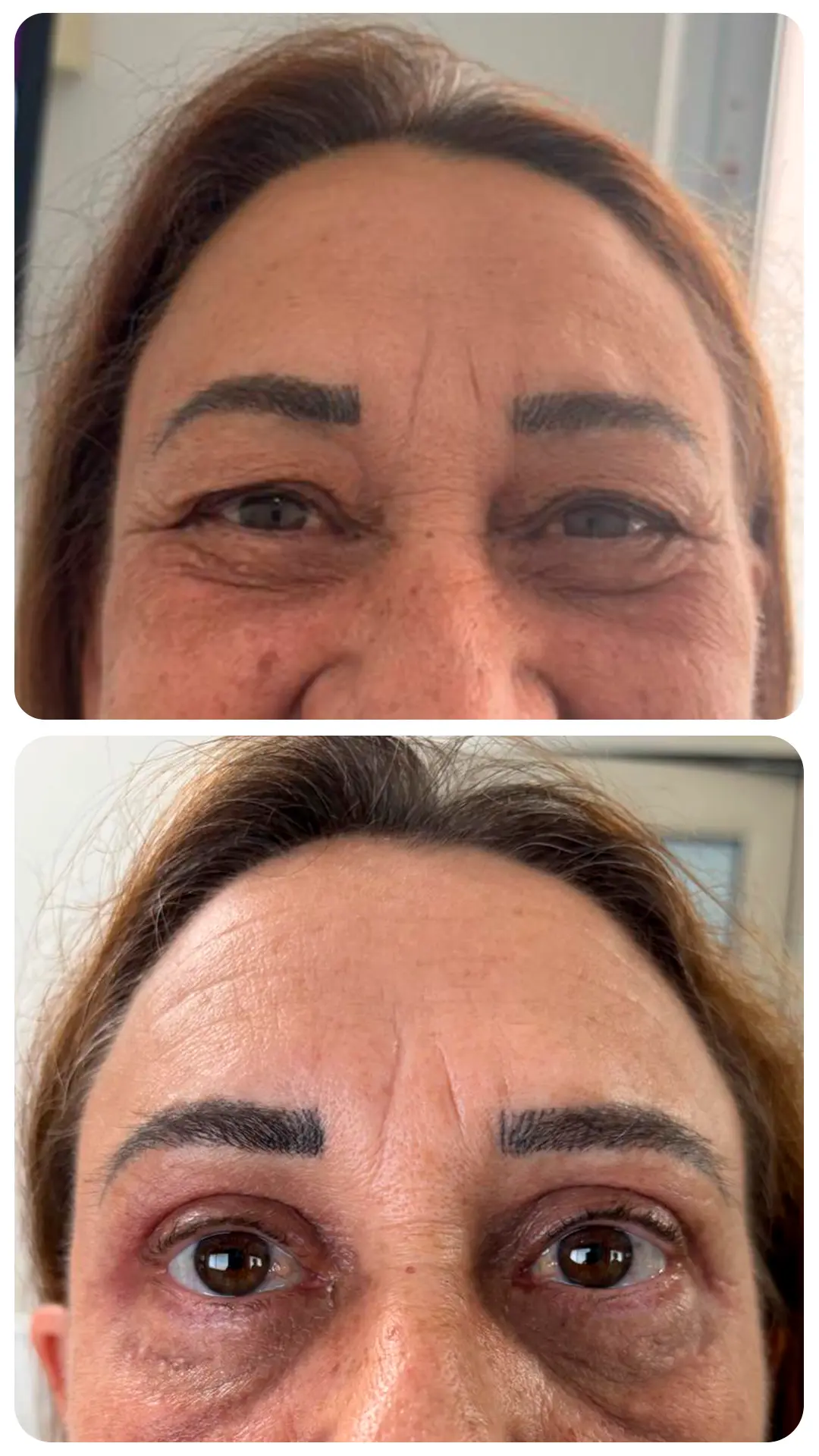 Blefaroplastia — antes e depois (caso 4)