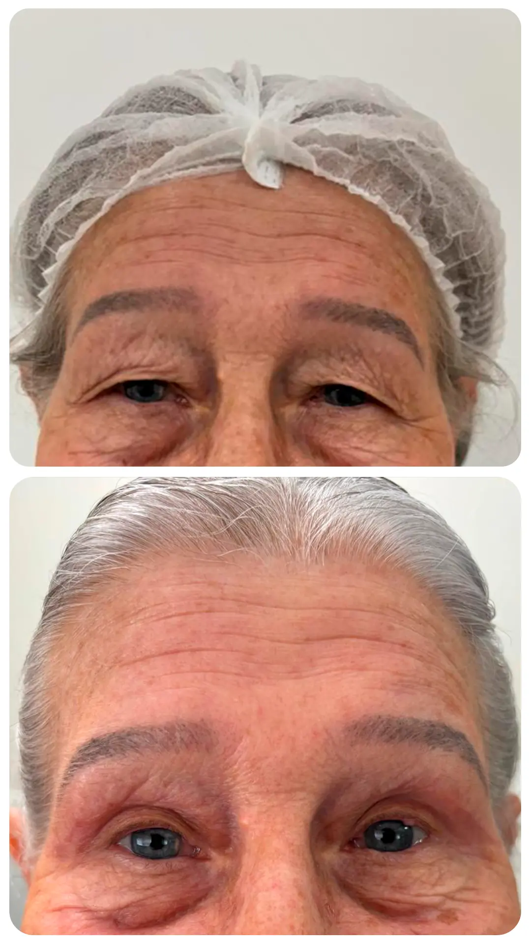 Blefaroplastia — antes e depois (caso 5)