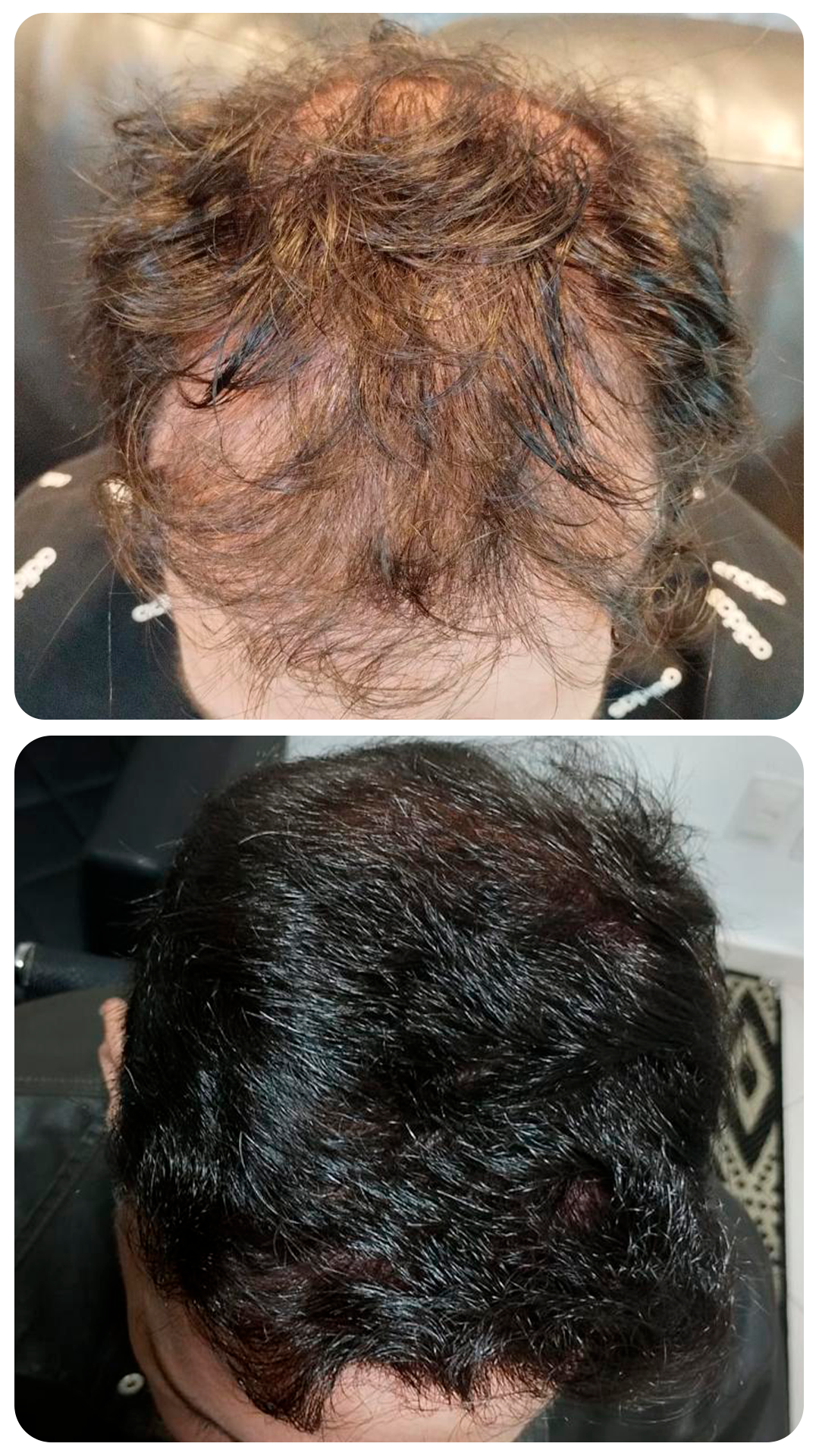 Transplante capilar masculino — antes e depois (caso 1)