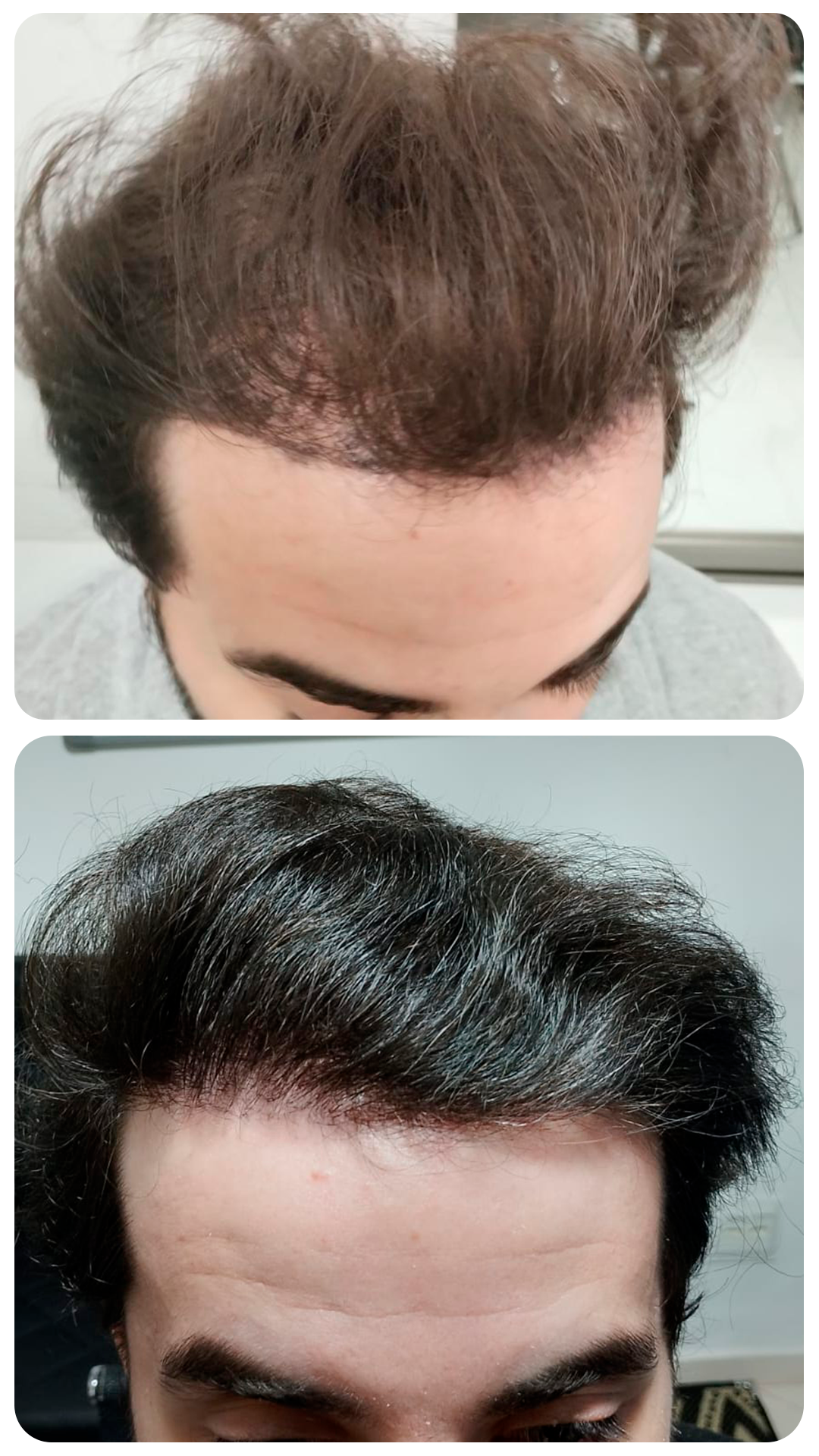 Transplante capilar masculino — antes e depois (caso 3)